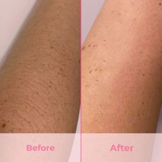 IPL Pulsed Light Hair Removal Technology